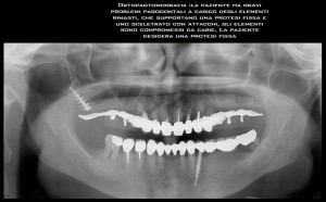 Foto 2 - Impianto dentale endosseo