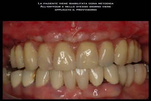Foto 3 - Impianto dentale endosseo