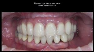Foto 5 - Impianto dentale endosseo